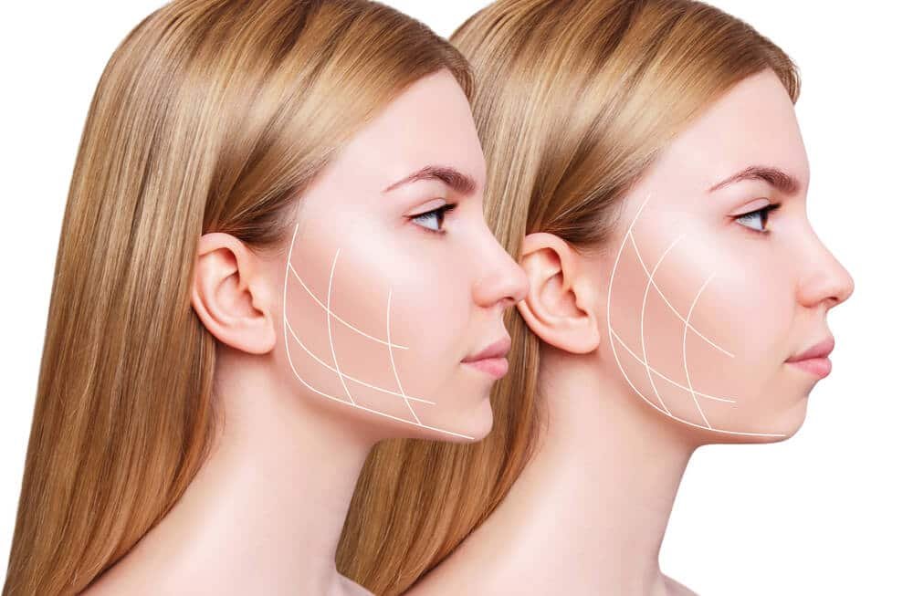 Çene Hattı Jawline Dolgusu